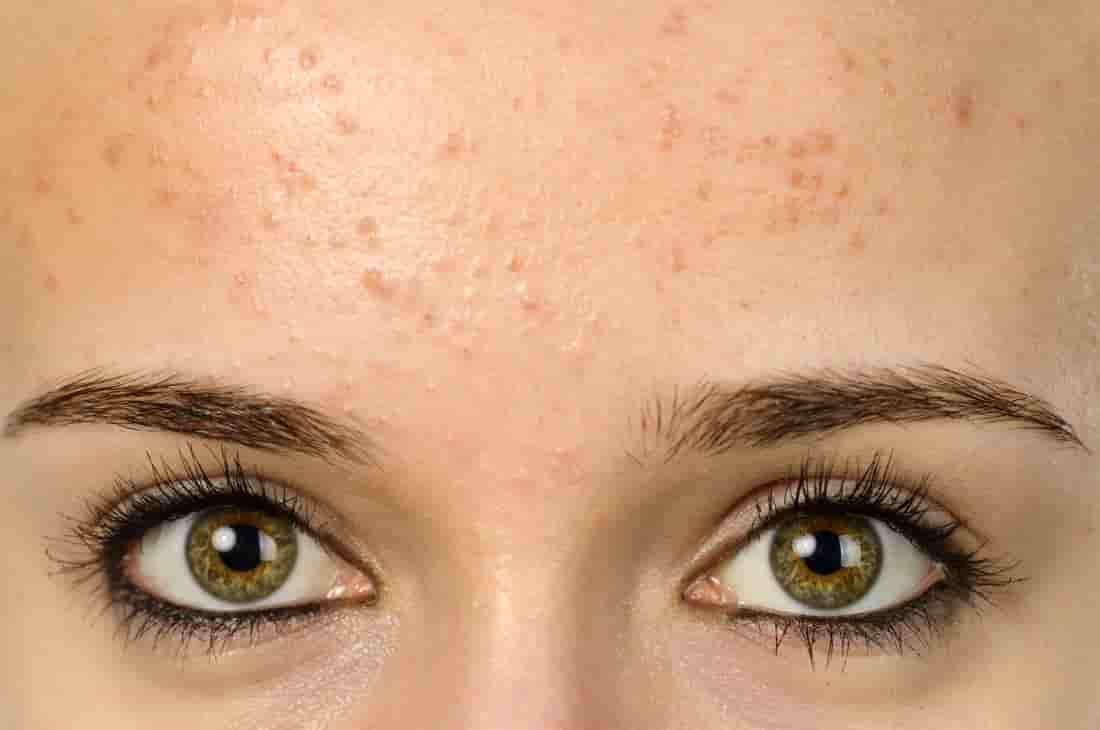 acne-types-how-to-recognize-what-kind-of-acne-you-have-types-of-acne