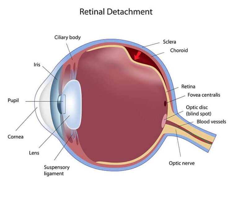 what-is-eye-jelly-vitreous-what-is-vitreous-detachment