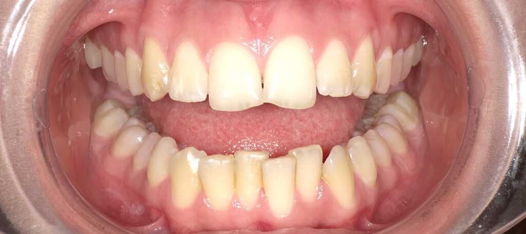 Metal Braces: Advantages And Disadvantages